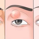 Можно ли гулять с ячменем: стоит ли выходить на улицу, в баню, в ...