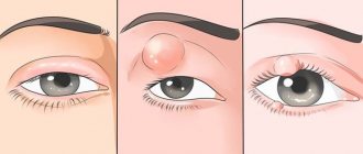 Можно ли гулять с ячменем: стоит ли выходить на улицу, в баню, в ...