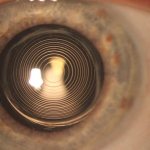 Мультифокальные интраокулярные линзы