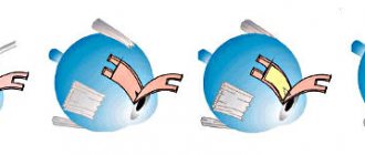 Непроникающая глубокая склерэктомия (НГСЭ) - операция при глаукоме