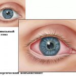 Норма и конъюктивит