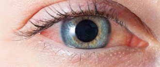 Офтальмологи называют конъюнктивитом воспаление слизистой глаза