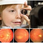 Офтальмоскопия: признаки 2-4 стадии болезни Беста