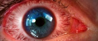 опасность геморрагического конъюнктивита