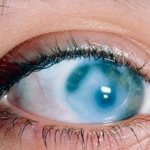 Опасные эксперименты с МКЛ: можно ли надевать одни на другие или носить линзу только на левом или правом глазу?