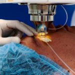 оперативное лечение катаракты