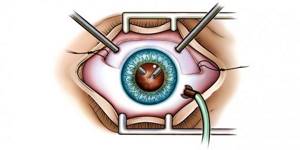 оперативное вмешательство при лечении отслоения сетчатки глаза