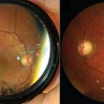 Ощущение песка в глазах. Причины и лечение, что это, что делать