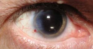 Осложнения лазерной коррекции зрения (возможные риски ...
