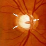 От чего возникает глаукома