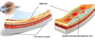 Отечная макула