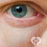 Отечные мешки под глазами могут быть вызваны заболеваниями почек