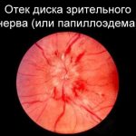Отек диска зрительного нерва (папиллоэдема)