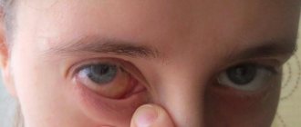 Swelling of the eye