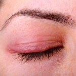 Отеки на бровях