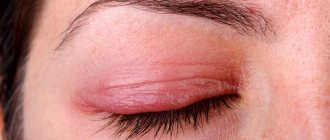 Swelling on the eyebrows