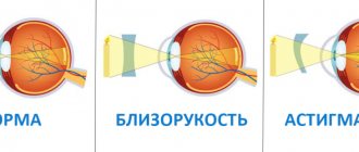 Differences between astigmatism and myopia (myopia)