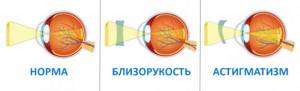 Дальнозоркость и близорукость (физика): описание заболевания, отличия ...