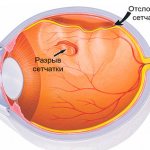 Отслоение сетчатки глаза
