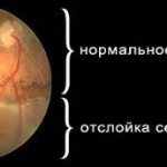 Retinal detachment