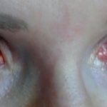 eye burn after eyelash extensions