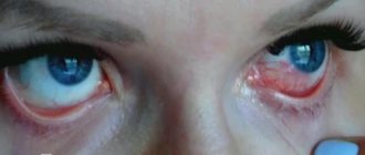 ожог глаз после наращивания ресниц