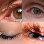Papilloma on the eyelid removal using folk remedies