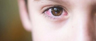is conjunctivitis transmitted in children?