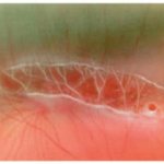 Периферическая дистрофия или след улитки на сетчатке глаза: какие риски несет заболевание?