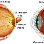 Пигментный ретинит симптомы