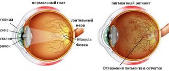 Пигментный ретинит симптомы