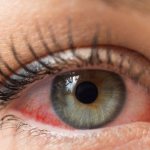 Why do my eyes turn red after eyelash extensions?