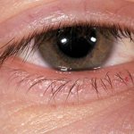 Why does a lump appear on the eye: causes, symptoms, possible diseases and prevention