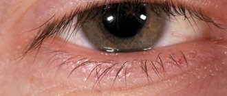 Почему появляется шишка на глазу: причины, симптомы, возможные заболевания и профилактика