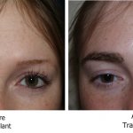 Почему выпадают ресницы