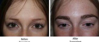 Why do eyelashes fall out?