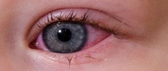 Redness of the eye in a small child