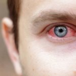 Порой конъюнктивит является разновидностью аллергической реакции организма