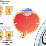 После операции глаукомы рекомендации