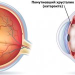 Повторное возникновение вторичной катаракты характеризуется помутнением, уплотнением и утратой эластичности задней капсулы хрусталика зрительной системы