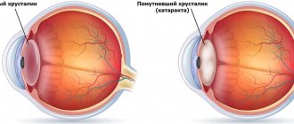 Повторное возникновение вторичной катаракты характеризуется помутнением, уплотнением и утратой эластичности задней капсулы хрусталика зрительной системы