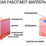 преимущества филлеров под глаза