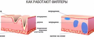 преимущества филлеров под глаза