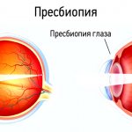 Presbyopia