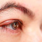 причины мейбомиевого блефарита