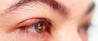 причины мейбомиевого блефарита