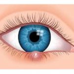 Прыщ на веке