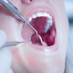 пузырек во рту на слизистой