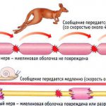Рассеянный склероз