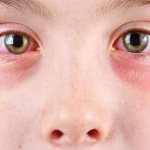 A reaction upon contact with an allergen occurs very quickly